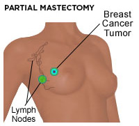 Mastectomy, Surgical removal of the breast