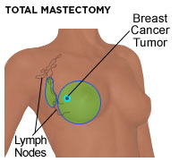 Lumpectomy, Surgical removal of the breast