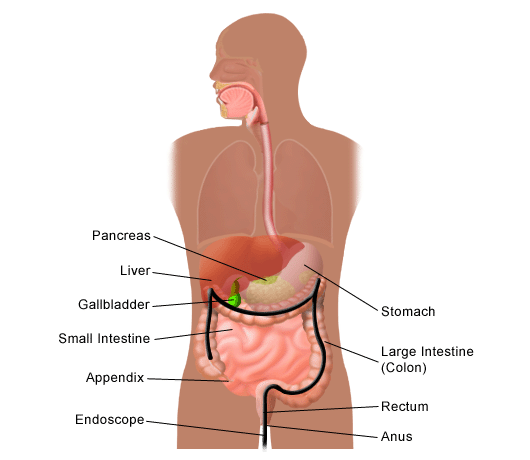 Colorectal Colon Cancer 