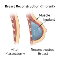 Breast Reconstruction(Implant)