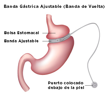 Banda Gástrica Ajustable (Banda de Vuelta)