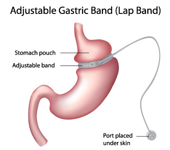 Laparoscopic Adjustable Gastric Band (Lap-Band)