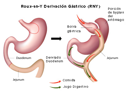 Roux-en-Y Derivación Gástrico (RNY)