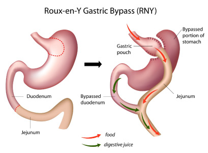 Bariatrics Gastric Bypass Illustration / Roux-en-Y Gastric Bypass (RNY)