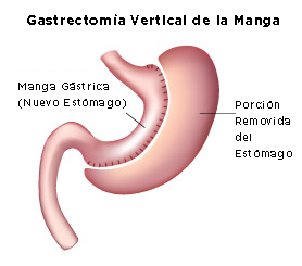 Gastrectomia Vertical de Manga