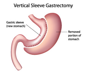 Bariatrics Gastric Sleeve Illustration / Vertical Sleeve Gastrectomy