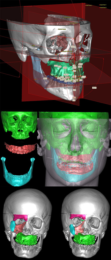 Virtual Surgical Planning