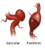 Saccular and Fusiform