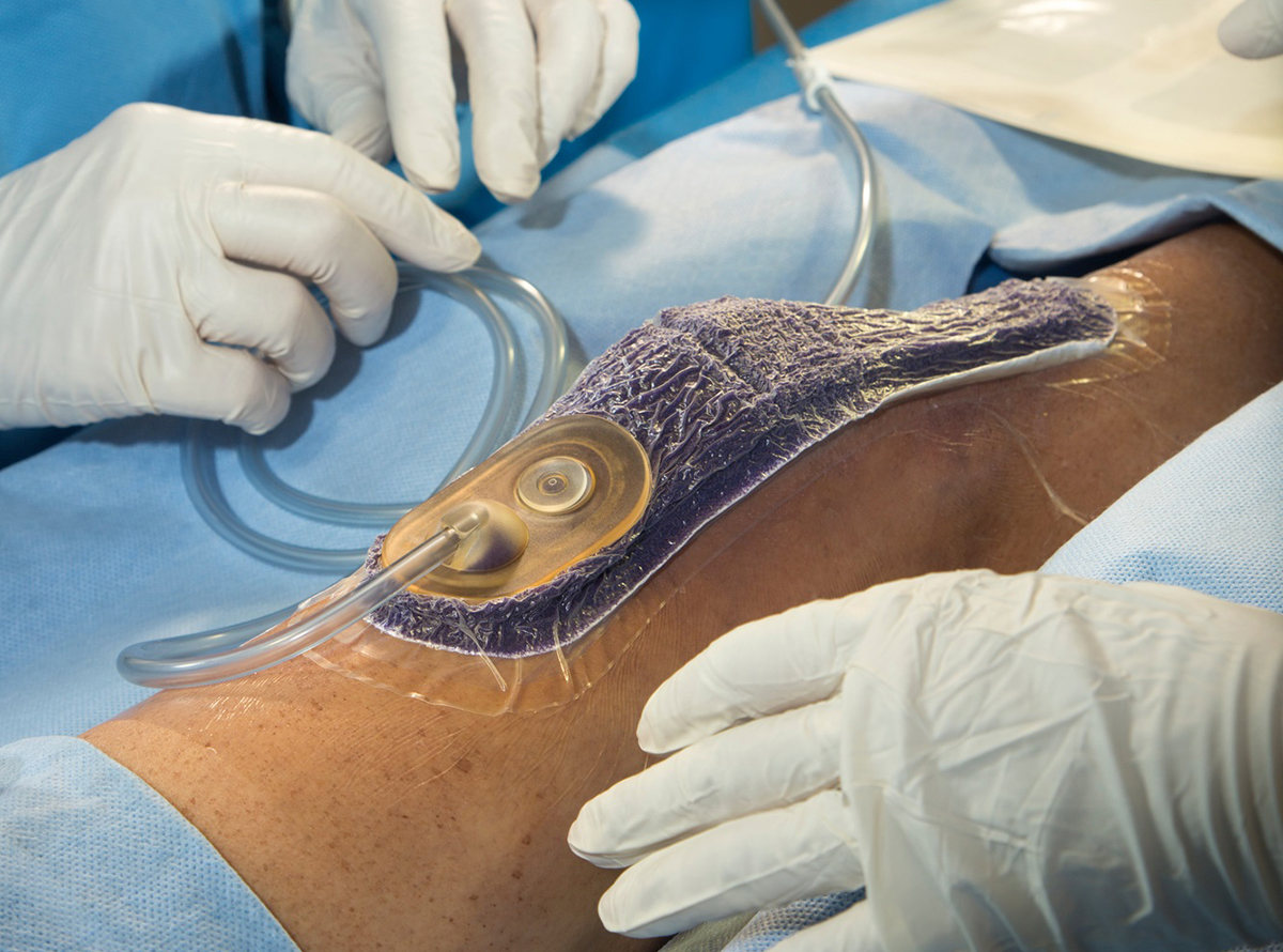 Negative pressure wound therapy device.