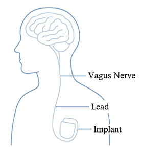 Diagram of Vagus-Nerve-Stimulation