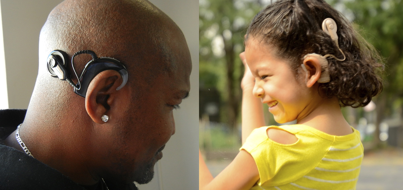 cochlear implants photos