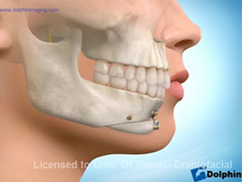 Chin Deformities After