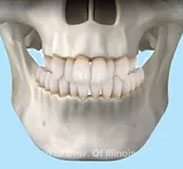 Narrow Upper Jaw