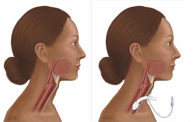 Tracheostomy