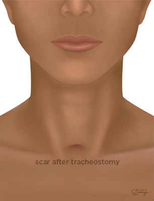 Tracheostomy Scar