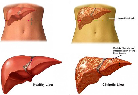 Liver Transplant